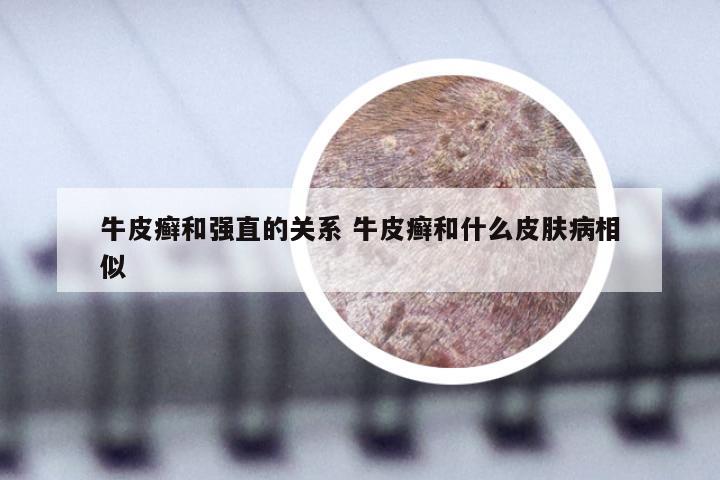 牛皮癣和强直的关系 牛皮癣和什么皮肤病相似