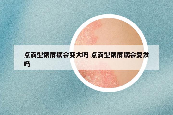 点滴型银屑病会变大吗 点滴型银屑病会复发吗