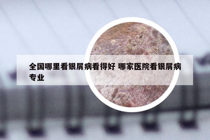 全国哪里看银屑病看得好 哪家医院看银屑病专业