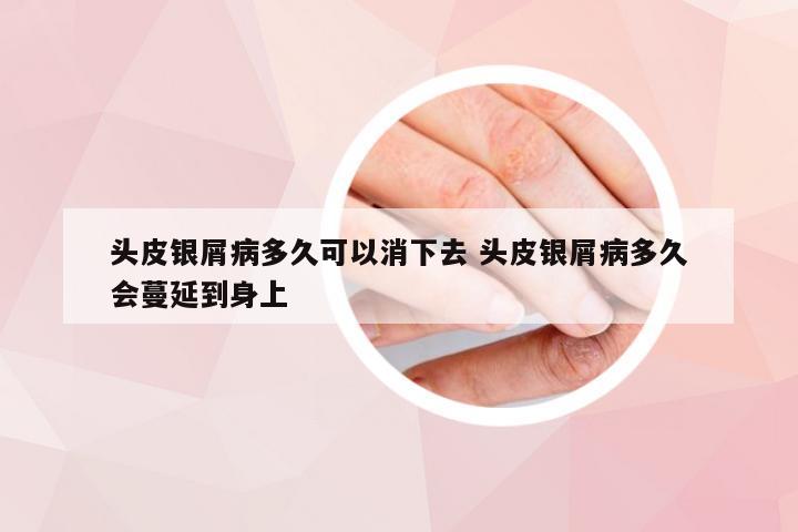 头皮银屑病多久可以消下去 头皮银屑病多久会蔓延到身上