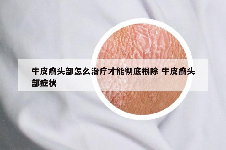 牛皮癣头部怎么治疗才能彻底根除 牛皮癣头部症状