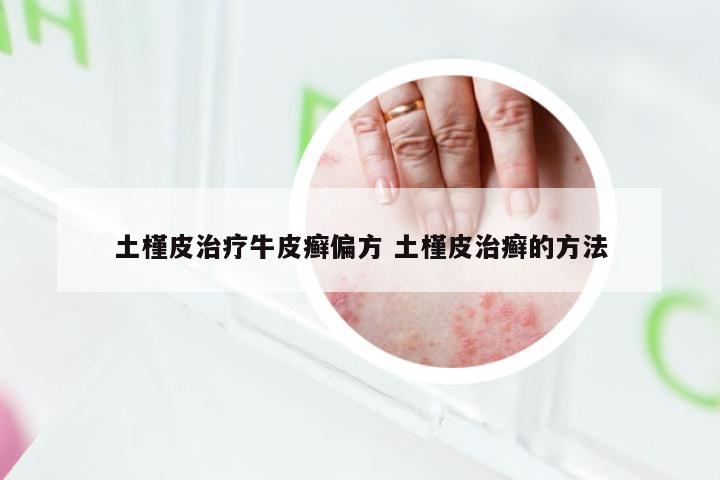 土槿皮治疗牛皮癣偏方 土槿皮治癣的方法