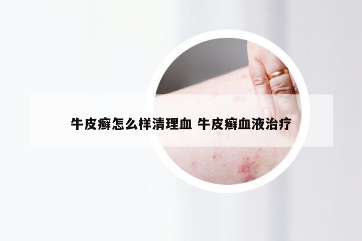 牛皮癣怎么样清理血 牛皮癣血液治疗