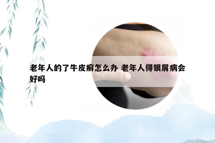 老年人的了牛皮癣怎么办 老年人得银屑病会好吗