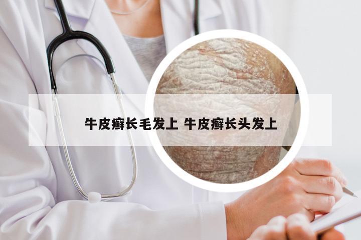 牛皮癣长毛发上 牛皮癣长头发上