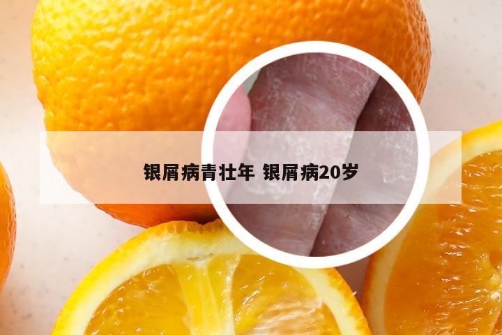 银屑病青壮年 银屑病20岁