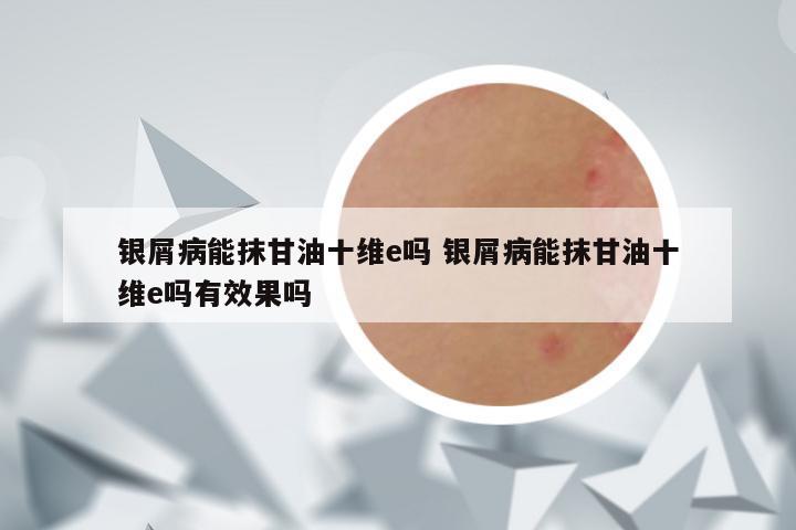 银屑病能抹甘油十维e吗 银屑病能抹甘油十维e吗有效果吗