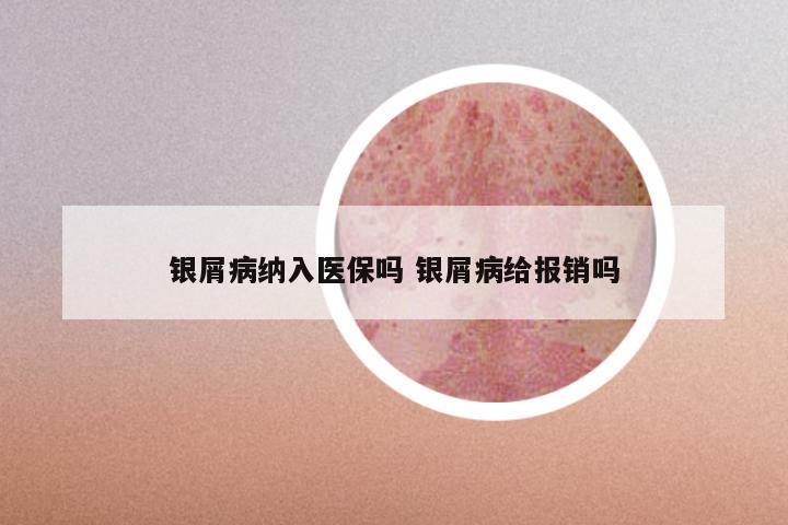 银屑病纳入医保吗 银屑病给报销吗