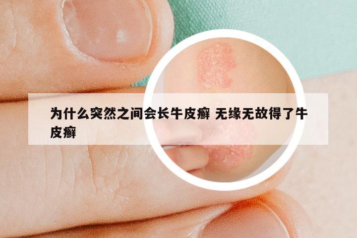 为什么突然之间会长牛皮癣 无缘无故得了牛皮癣