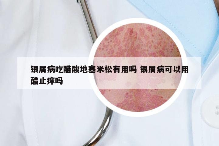 银屑病吃醋酸地塞米松有用吗 银屑病可以用醋止痒吗