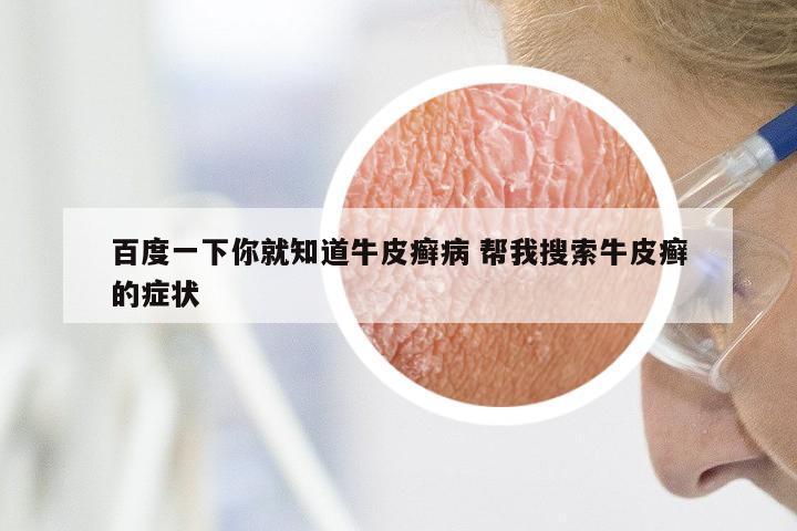 百度一下你就知道牛皮癣病 帮我搜索牛皮癣的症状