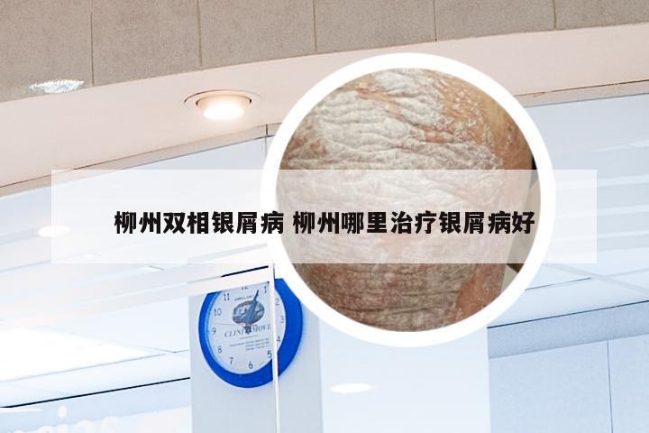 柳州双相银屑病 柳州哪里治疗银屑病好