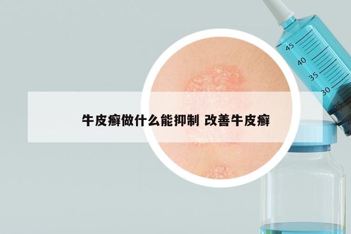 牛皮癣做什么能抑制 改善牛皮癣