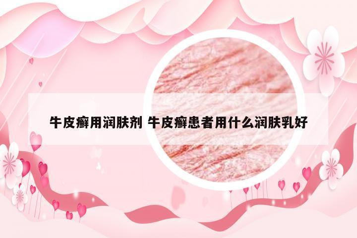 牛皮癣用润肤剂 牛皮癣患者用什么润肤乳好
