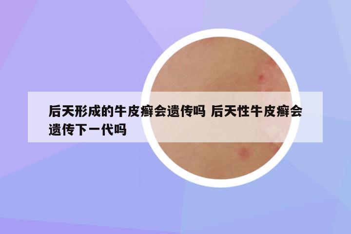 后天形成的牛皮癣会遗传吗 后天性牛皮癣会遗传下一代吗