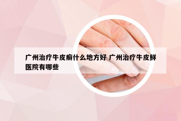 广州治疗牛皮癣什么地方好 广州治疗牛皮鲜医院有哪些