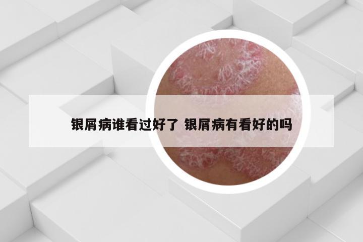银屑病谁看过好了 银屑病有看好的吗