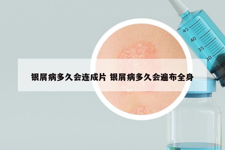 银屑病多久会连成片 银屑病多久会遍布全身