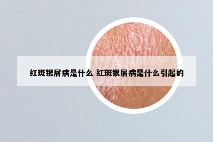 红斑银屑病是什么 红斑银屑病是什么引起的