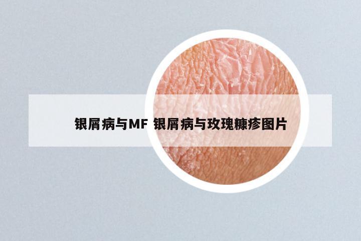 银屑病与MF 银屑病与玫瑰糠疹图片