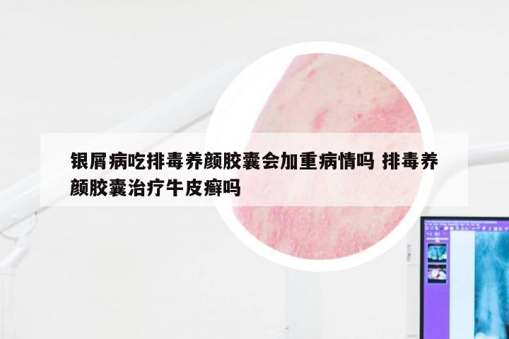 银屑病吃排毒养颜胶囊会加重病情吗 排毒养颜胶囊治疗牛皮癣吗