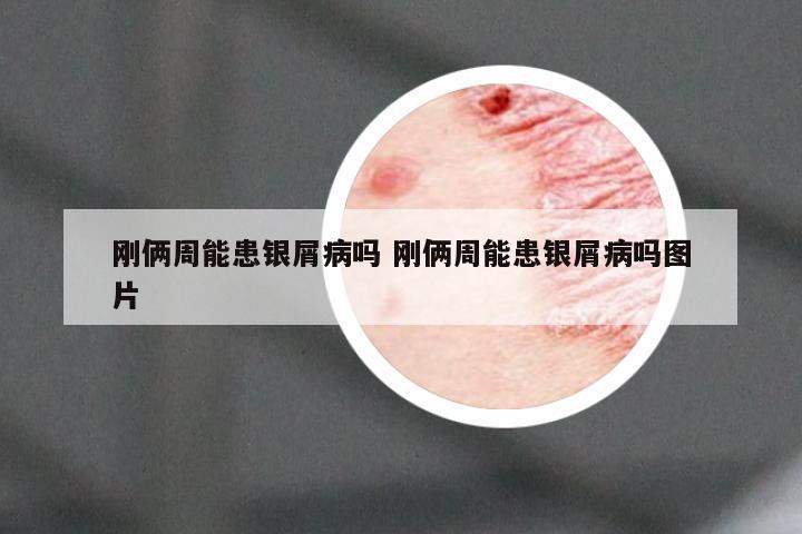 刚俩周能患银屑病吗 刚俩周能患银屑病吗图片