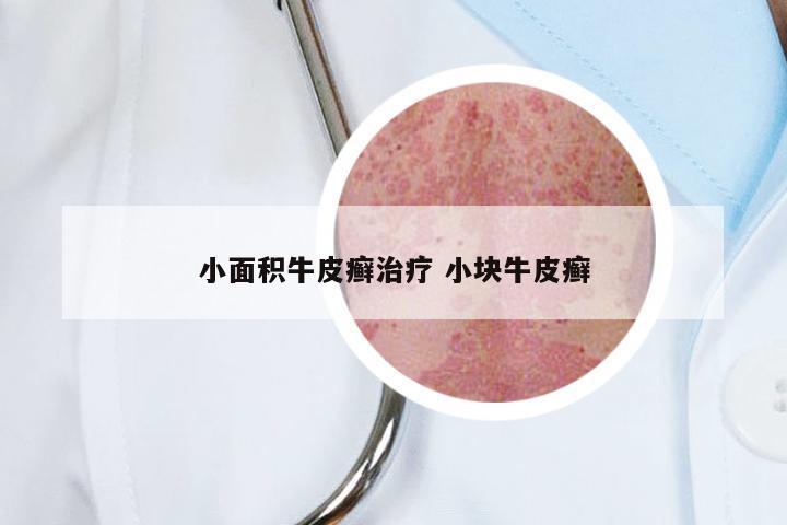 小面积牛皮癣治疗 小块牛皮癣