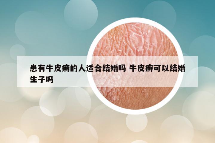 患有牛皮癣的人适合结婚吗 牛皮癣可以结婚生子吗