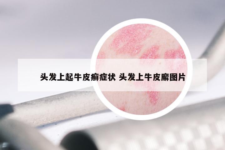 头发上起牛皮癣症状 头发上牛皮廨图片