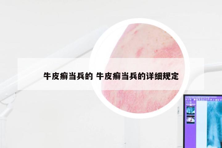 牛皮癣当兵的 牛皮癣当兵的详细规定