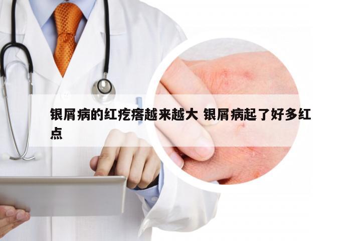 银屑病的红疙瘩越来越大 银屑病起了好多红点