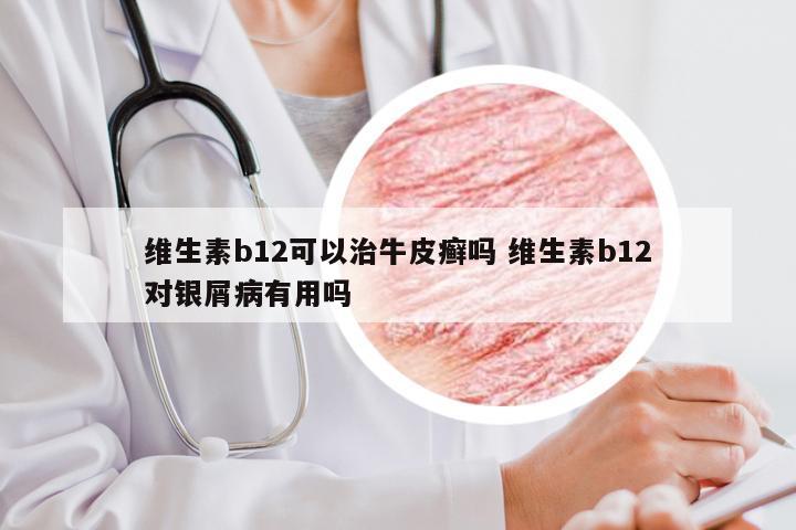 维生素b12可以治牛皮癣吗 维生素b12对银屑病有用吗