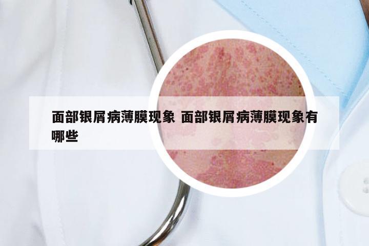 面部银屑病薄膜现象 面部银屑病薄膜现象有哪些