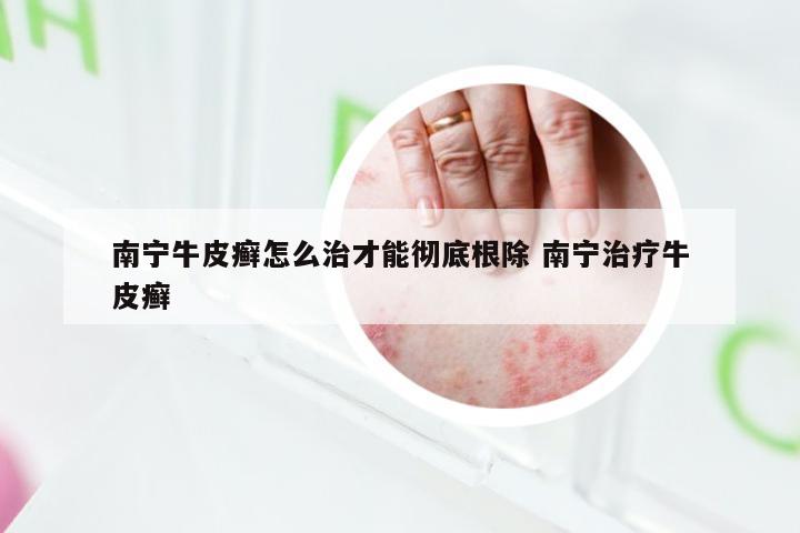 南宁牛皮癣怎么治才能彻底根除 南宁治疗牛皮癣