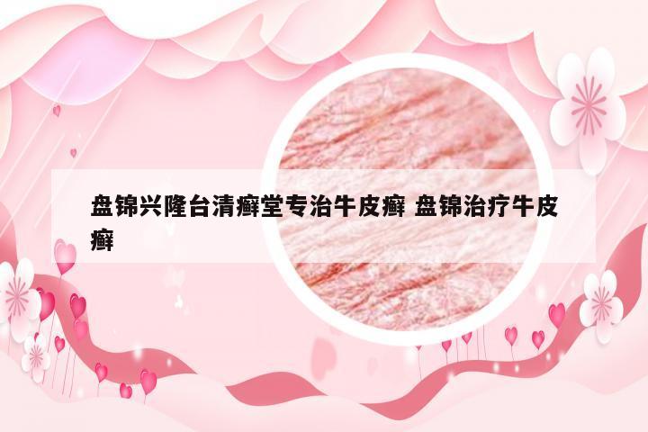 盘锦兴隆台清癣堂专治牛皮癣 盘锦治疗牛皮癣