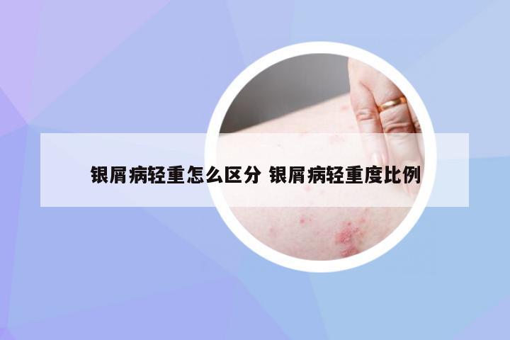 银屑病轻重怎么区分 银屑病轻重度比例