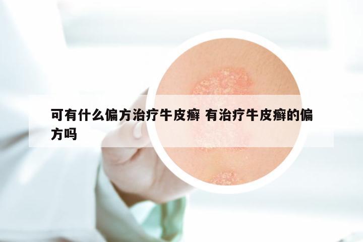 可有什么偏方治疗牛皮癣 有治疗牛皮癣的偏方吗
