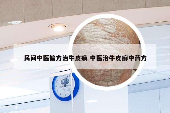 民间中医偏方治牛皮癣 中医治牛皮癣中药方