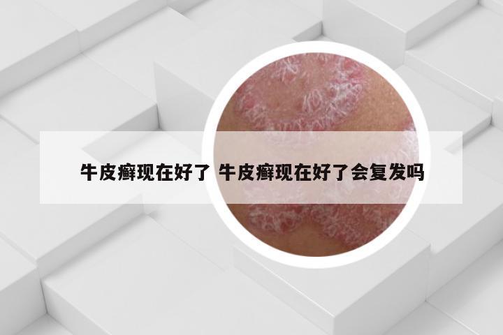 牛皮癣现在好了 牛皮癣现在好了会复发吗