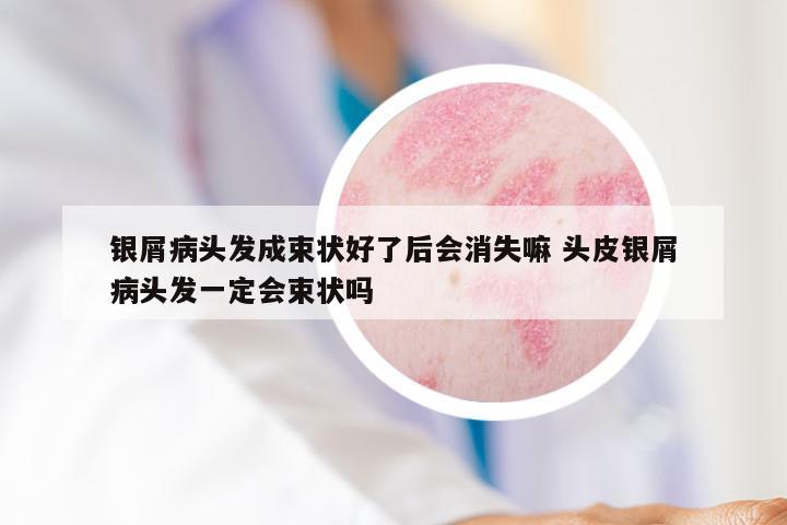 银屑病头发成束状好了后会消失嘛 头皮银屑病头发一定会束状吗