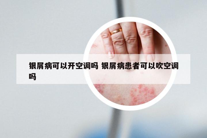 银屑病可以开空调吗 银屑病患者可以吹空调吗