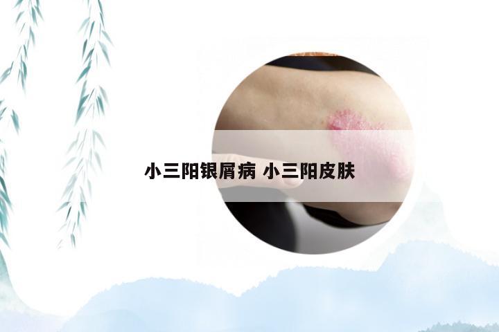 小三阳银屑病 小三阳皮肤