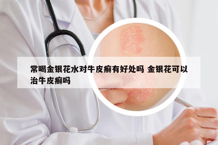 常喝金银花水对牛皮癣有好处吗 金银花可以治牛皮癣吗