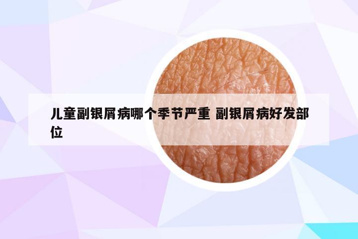 儿童副银屑病哪个季节严重 副银屑病好发部位