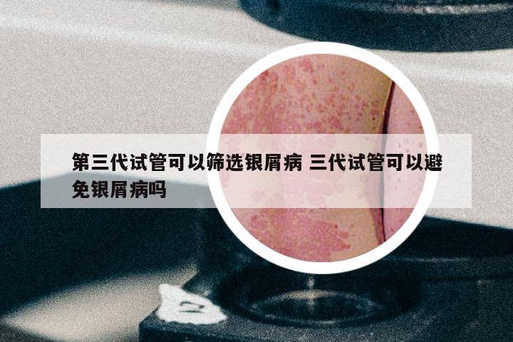 第三代试管可以筛选银屑病 三代试管可以避免银屑病吗