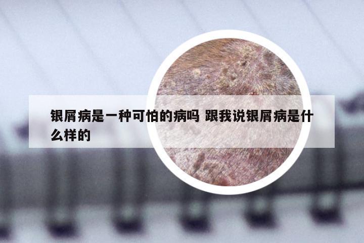 银屑病是一种可怕的病吗 跟我说银屑病是什么样的