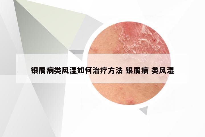 银屑病类风湿如何治疗方法 银屑病 类风湿