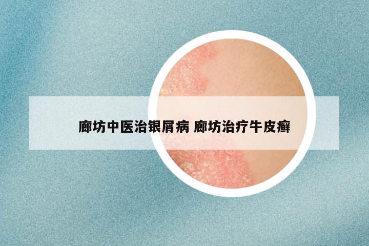 廊坊中医治银屑病 廊坊治疗牛皮癣