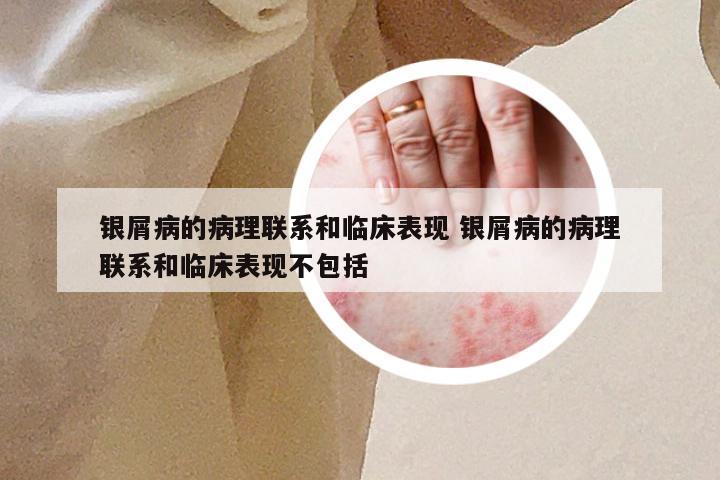 银屑病的病理联系和临床表现 银屑病的病理联系和临床表现不包括