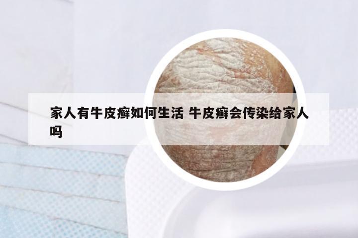 家人有牛皮癣如何生活 牛皮癣会传染给家人吗